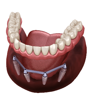 Smiling patient receiving professional dental care at Dover Dental in Newport Beach and Costa Mesa.