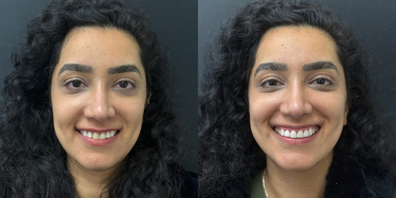 bonding to repair chipped front teeth